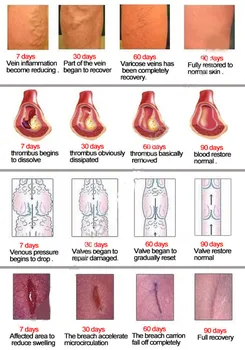 12Pcs Krčne Žile Zdravljenje Krema za Deževnike noge Vaskulitis Angitis Zdravilo Proti Stopala Noge Vaskulitis Phlebitis