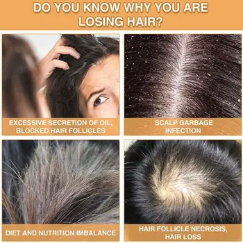 30 ml 7X Hitro Rast Las Zdravljenja Anti Hair Loss Hitro Rast Las Serum Ingver Eterično Olje Za Napredno Redčenje Las