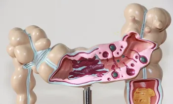4D Življenje Velikost Človekovih Bolezni Debelega črevesa Model debelega Črevesa, Patološki Model Gastroenterologija Pomoči Anatomski Medicinske Lobanje