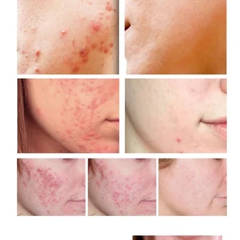 Anti Acne Removal Cream Zdravljenje Aken Zbledi Akne Madeži Olja Nadzor Skrči Pore Zob Rumene, Akne Krema za Nego Kože, 15g