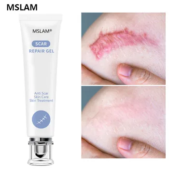 MSLAM Scar Removal Gel za Odstranjevanje Strectch Znamke Brazgotin Aken Krema Ance Zdravljenje Pigmentacije Korektor za Beljenje Koža Popravila Nego